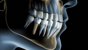 Implant Dentistry